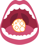 cannabis - cancer buccal