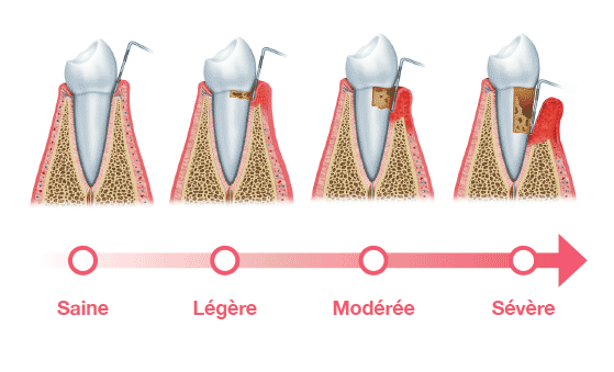 progression of perodontitis