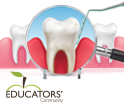 AAP Periodontal Disease Classification System for Educators thumbnail