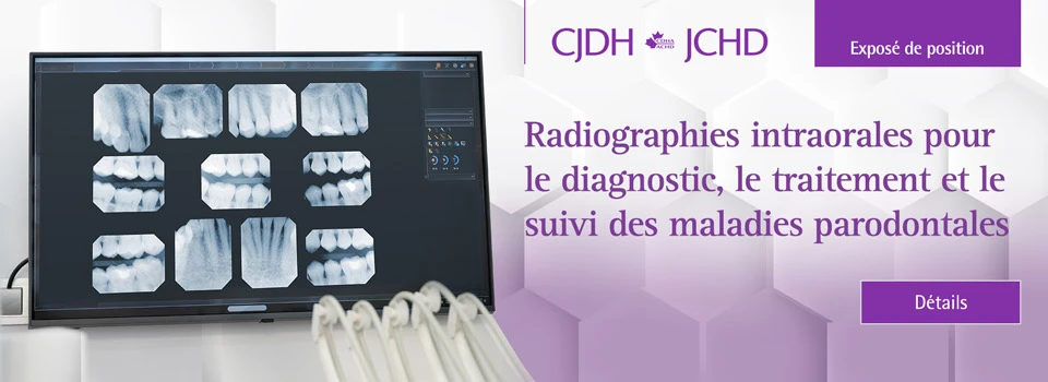 Radiographies intraorales pour le diagnostic, le traitement et le suivi des maladies parodontales