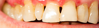 Periodontitis